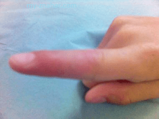 Перелом пальца на руке, симптомы и лечение