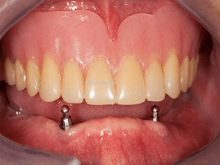 Условно-съемные протезы для зубов, какие они