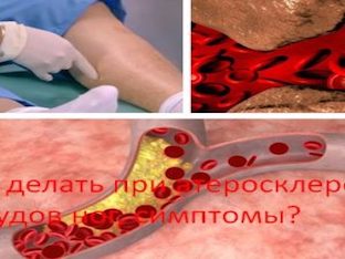 Что делать при атеросклероз сосудов ног, симптомы