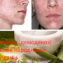 Демодекс (демодекоз) лечение народными методами