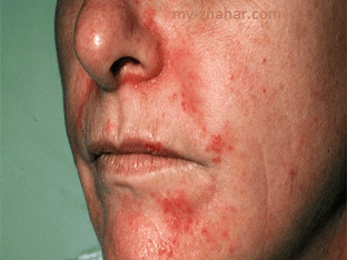 Как лечить себорейный дерматит на лице