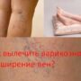 Как вылечить варикозное расширение вен?