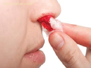 Как остановить кровотечения из носа