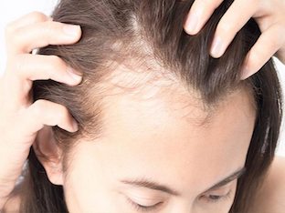 Какие могут быть причины выпадения волос(облысение) у женщин, как лечить