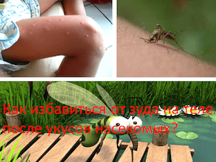 Как избавиться от зуда на теле после укусов насекомых