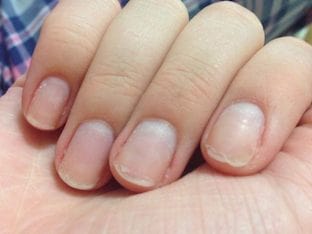 Почему слоятся ногти на руках и чем лечить