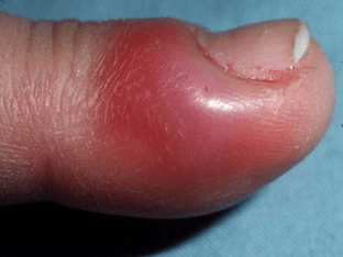 Нарыв на пальце возле ногтя – панариций: как лечить