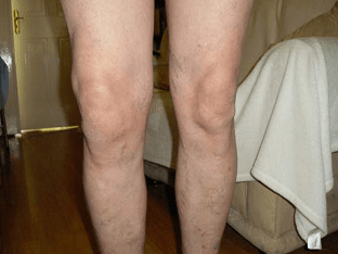 Как вылечить артроз коленного сустава - лучшие методы!