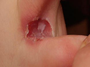 Трещины на пальцах ног: причины и лечение
