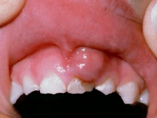 Как лечить десну, когда болит. Опухла десна около зуба, что делать?