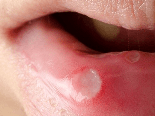 Чем лечить стоматит во рту у взрослых?