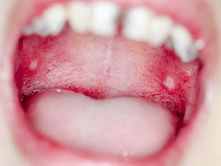 Чем лечить стоматит во рту?