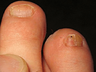 Методы быстрого и эффективного лечения грибка ногтей