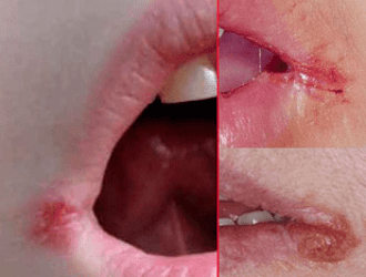 Причины появления трещин в уголках губ, лечение заед в углах рта