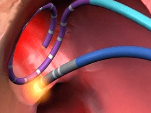 РЧА сердца (радиочастотная абляция, прижигание): операция при аритмии