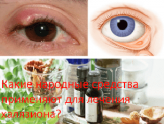 Какие народные средства применяют для лечения халязиона?