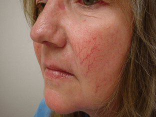 Купероз на лице: лечение сосудистой сетки