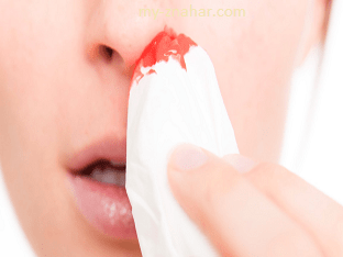 Что делать, когда идёт кровь из носа