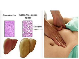 Как лечить жировой гепатоз печени