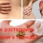 Как растворить камни в почках?