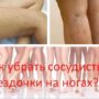 Как убрать сосудистые звездочки на ногах?