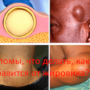 Липомы, что делать, как избавиться от жировика?