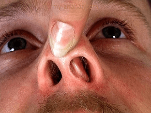 Что делать, если появилась сухость в носу