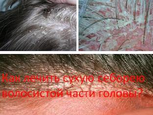 Как лечить сухую себорею волосистой части головы