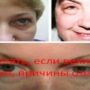 Что делать, если веки отекают, причины отеков?