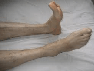 Что такое синдром беспокойных ног, его симптомы и лечение