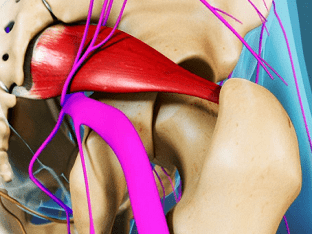 Как лечить защемление седалищного нерва