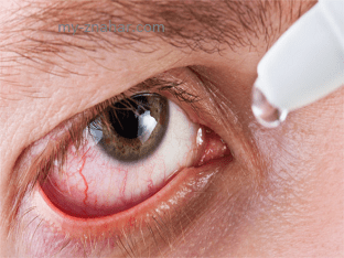Помощь при воспалительных заболеваниях глаз