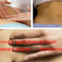 Селезенка увеличена, спленомегалия — причины