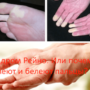 Синдром Рейно. Или почему немеют и белеют пальцы?