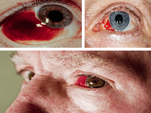 Что делать при кровоизлиянии в глаз, в чем причина