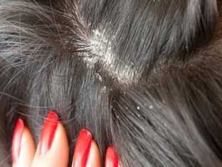 Как лечить себорею волосистой части головы