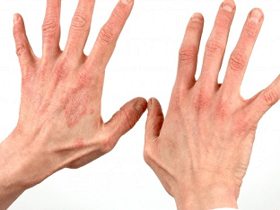 Как вылечить аллергический дерматит в домашних условиях