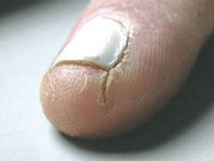 Как вылечить трещины на пальцах