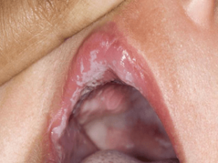 Белый налет во рту у грудничка: причины и лечение