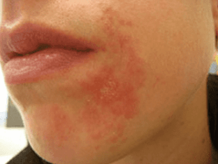 Чем лечить аллергию на лице у взрослого
