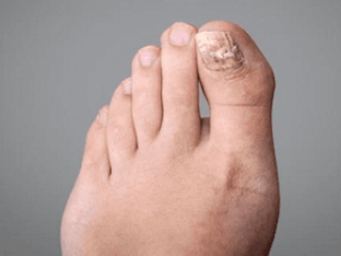 Чем лечить грибок ногтей на ногах