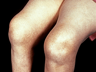 Как вылечить артроз коленного сустава