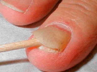 Мази против грибка ногтей: эффективные и недорогие