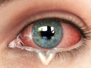 Причины появления и лечение белых выделений из глаз
