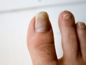 Выявляем признаки грибка на ногтях ног