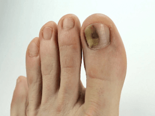 Как вылечить грибок ногтей на большом пальце ноги