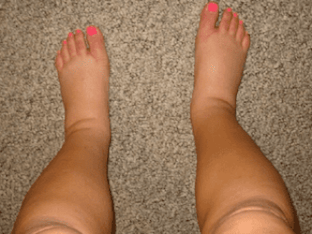 Отеки и отечность ног - основные причины