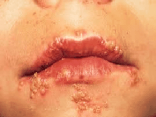 Причины возникновения и лечение герпеса на губах