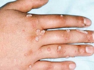 Папилломавирус – звездочки на коже