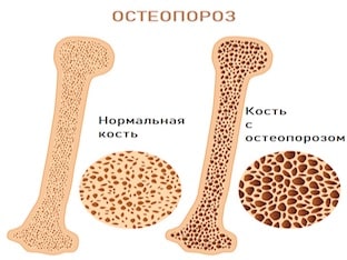 Причины остеопороза
